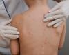 Chickenpox can cause serious complications – vaccinations help prevent them