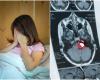 Doctors said he had migraines, but it was brain cancer: 2 symptoms betrayed the disease